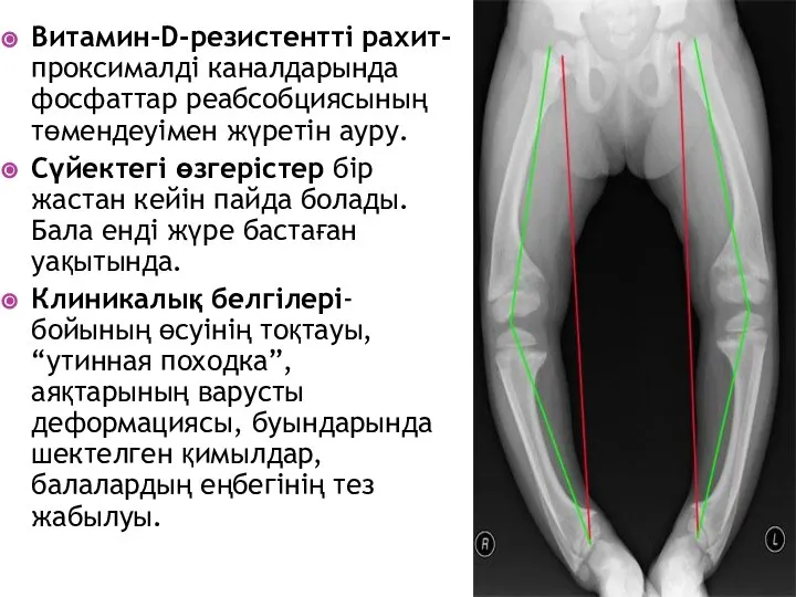 Витамин-D-резистентті рахит- проксималді каналдарында фосфаттар реабсобциясының төмендеуімен жүретін ауру. Сүйектегі өзгерістер