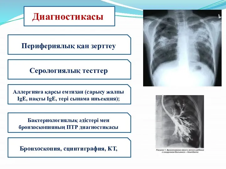 Диагностикасы: Перифериялық қан зерттеу Серологиялық тесттер Аллергияға қарсы емтихан (сарысу жалпы