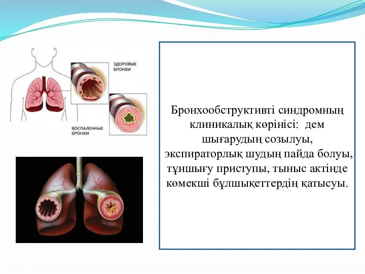 Бронхообструктивті синдромның клиникалық көрінісі: дем шығарудың созылуы, экспираторлық шудың пайда болуы,