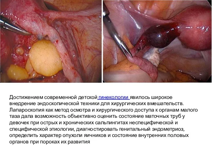 Достижением современной детской гинекологии явилось широкое внедрение эндоскопической техники для хирургических