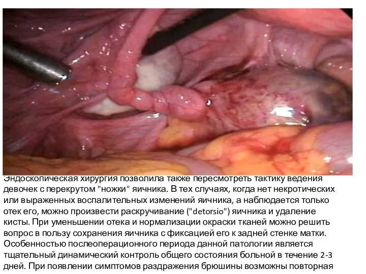 Эндоскопическая хирургия позволила также пересмотреть тактику ведения девочек с перекрутом "ножки"