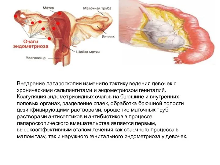 Внедрение лапароскопии изменило тактику ведения девочек с хроническими сальпингитами и эндометриозом