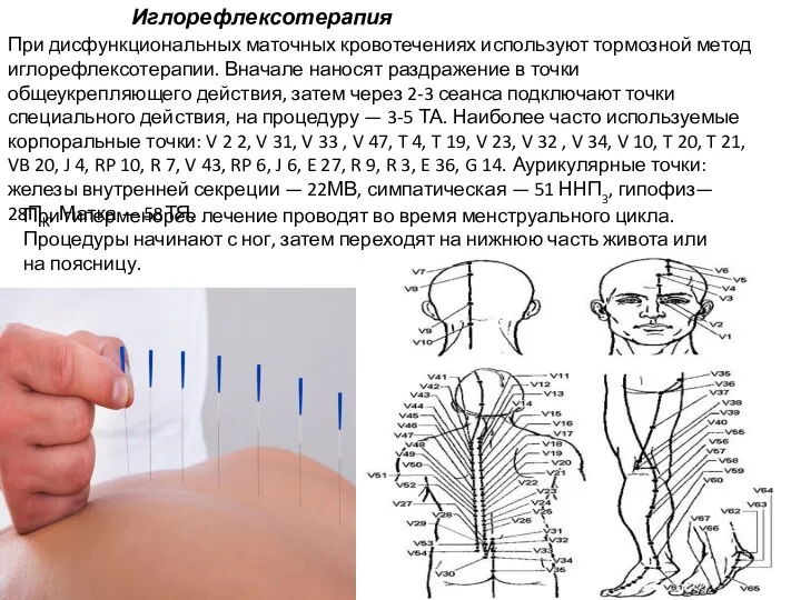 При дисфункциональных маточных кровотечениях используют тормозной метод иглорефлексотерапии. Вначале наносят раздражение