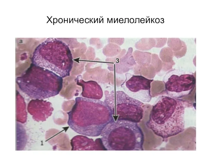 Хронический миелолейкоз