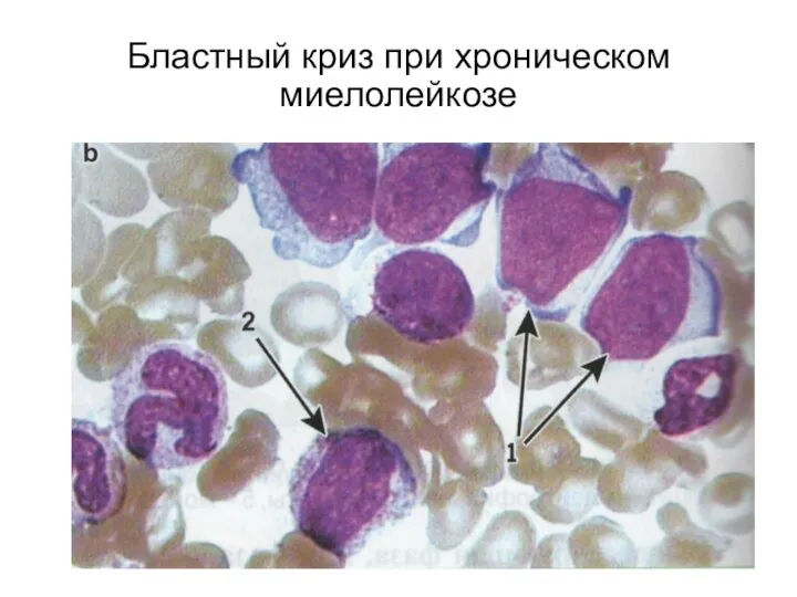 Бластный криз при хроническом миелолейкозе