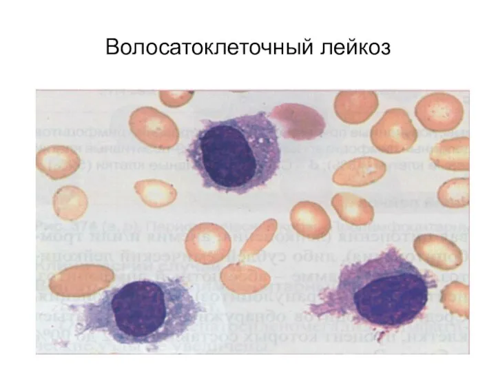 Волосатоклеточный лейкоз