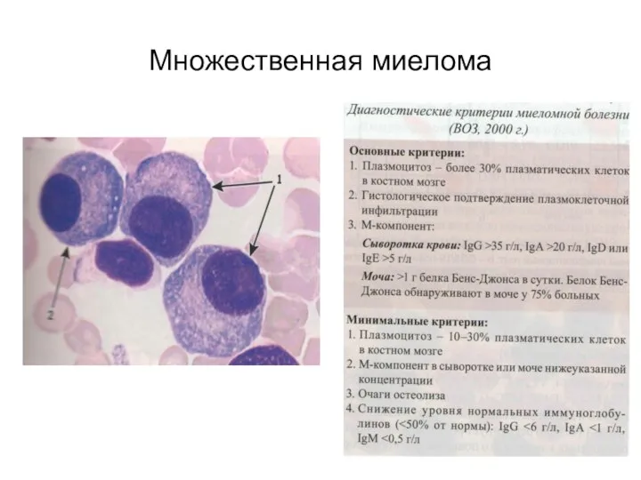 Множественная миелома