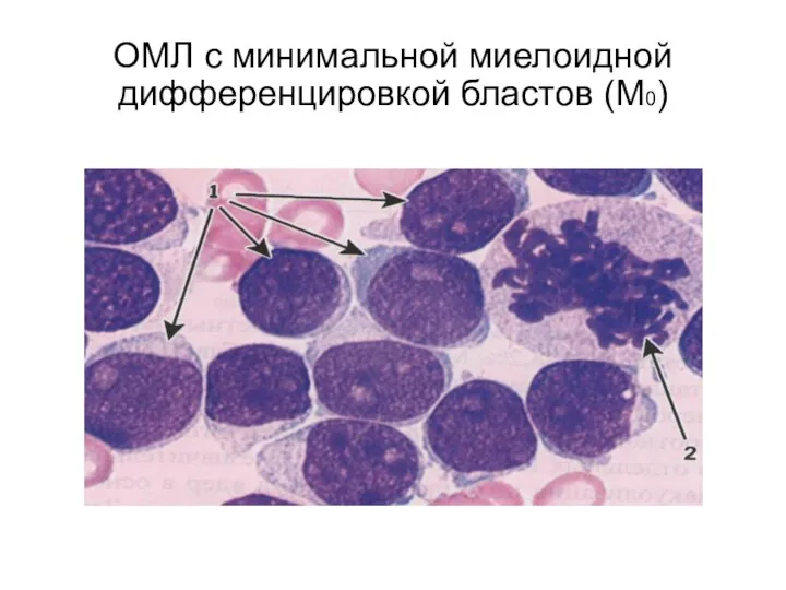 ОМЛ с минимальной миелоидной дифференцировкой бластов (М0)