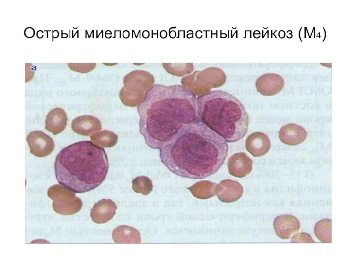 Острый миеломонобластный лейкоз (М4)