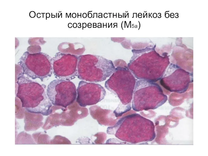 Острый монобластный лейкоз без созревания (М5а)