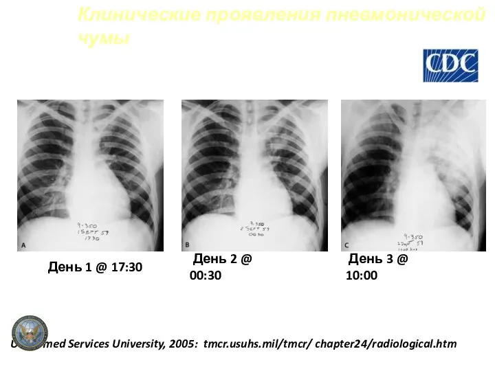 Клинические проявления пневмонической чумы День 1 @ 17:30 День 2 @