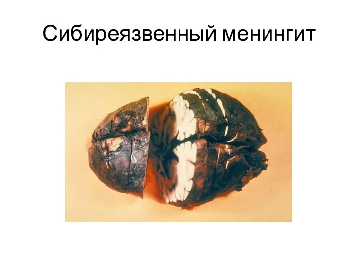 Сибиреязвенный менингит