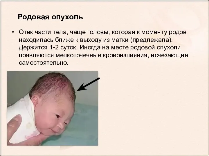 Родовая опухоль Отек части тела, чаще головы, которая к моменту родов