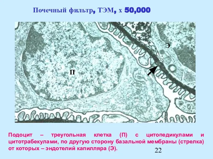 Подоцит – треугольная клетка (П) с цитопедикулами и цитотрабекулами, по другую