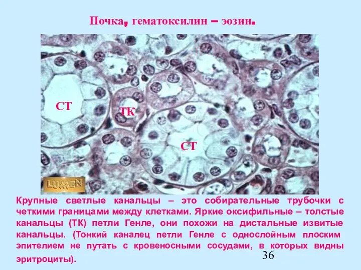 Крупные светлые канальцы – это собирательные трубочки с четкими границами между