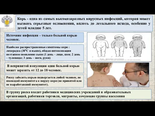 Корь - одна из самых высокозаразных вирусных инфекций, которая может вызвать