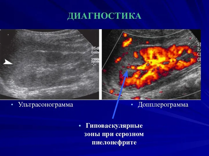 ДИАГНОСТИКА Ультрасонограмма Допплерограмма Гиповаскулярные зоны при серозном пиелонефрите