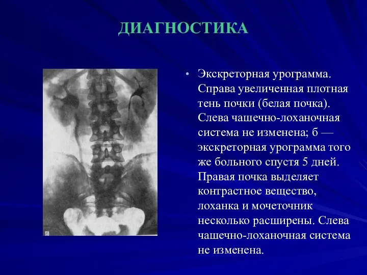 ДИАГНОСТИКА Экскреторная урограмма. Справа увеличенная плотная тень почки (белая почка). Слева