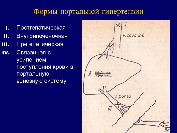 Формы портальной гипертензии Постгепатическая Внутрипечёночная Прегепатическая Связанная с усилением поступления крови в портальную венозную систему