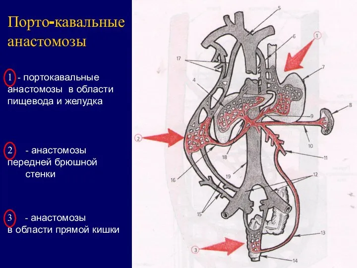 Порто-кавальные анастомозы 1 - портокавальные анастомозы в области пищевода и желудка