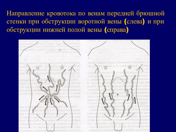 Направление кровотока по венам передней брюшной стенки при обструкции воротной вены