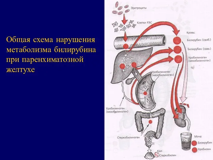 Общая схема нарушения метаболизма билирубина при паренхиматозной желтухе