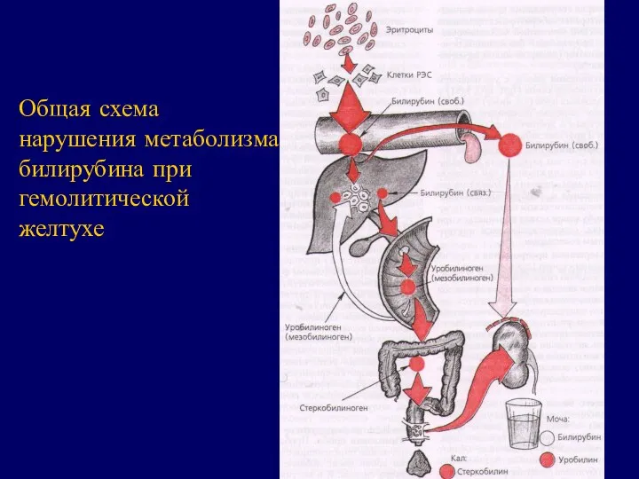 Общая схема нарушения метаболизма билирубина при гемолитической желтухе