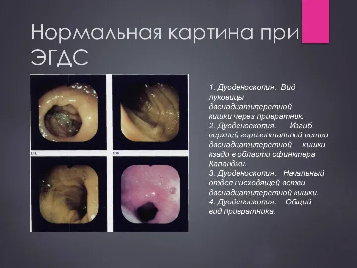 Нормальная картина при ЭГДС 1. Дуоденоскопия. Вид луковицы двенадцатиперстной кишки через