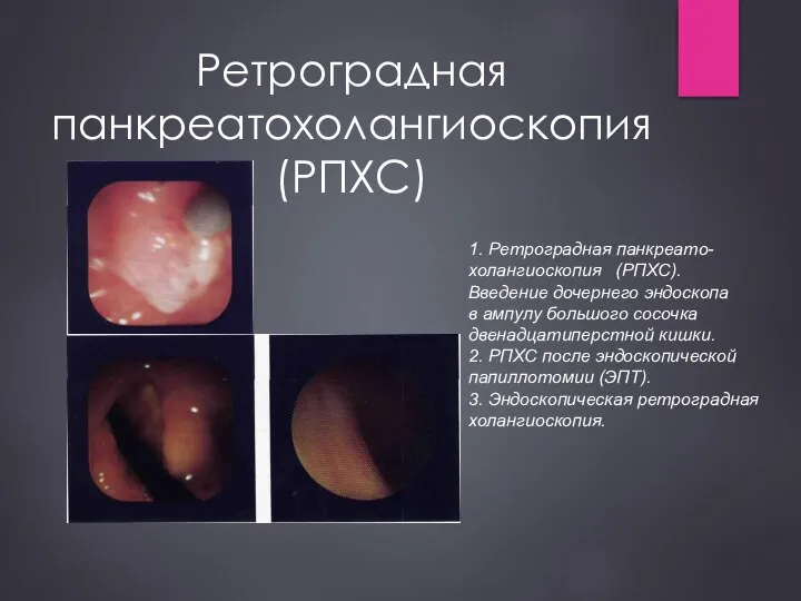 Ретроградная панкреатохолангиоскопия (РПХС) 1. Ретроградная панкреато- холангиоскопия (РПХС). Введение дочернего эндоскопа