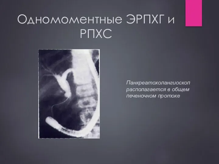 Одномоментные ЭРПХГ и РПХС Панкреатохолангиоскоп располагается в общем печеночном протоке