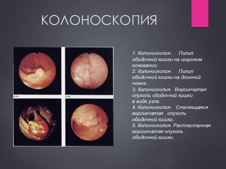 КОЛОНОСКОПИЯ 1. Колоноскопия. Полип ободочной кишки на широком основании. 2. Колоноскопия.