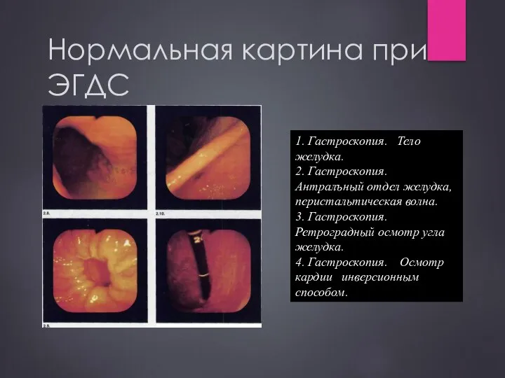 Нормальная картина при ЭГДС 1. Гастроскопия. Тело желудка. 2. Гастроскопия. Антралъный