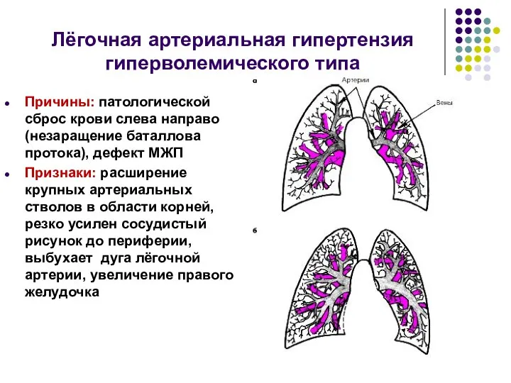 Лёгочная артериальная гипертензия гиперволемического типа Причины: патологической сброс крови слева направо