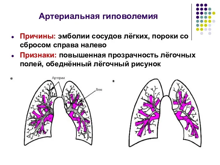 Артериальная гиповолемия Причины: эмболии сосудов лёгких, пороки со сбросом справа налево