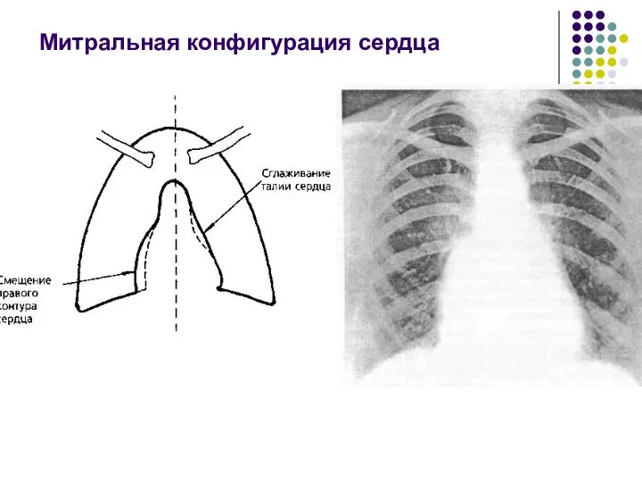 Митральная конфигурация сердца