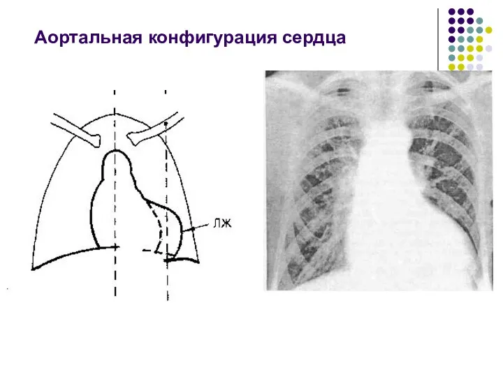 Аортальная конфигурация сердца