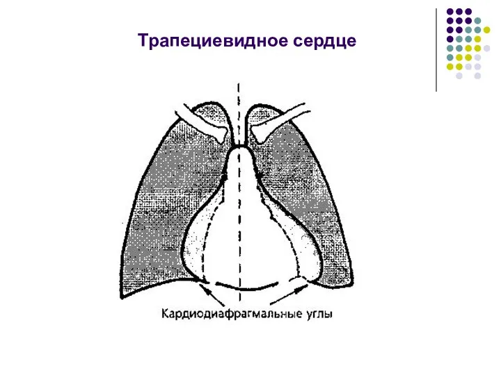 Трапециевидное сердце