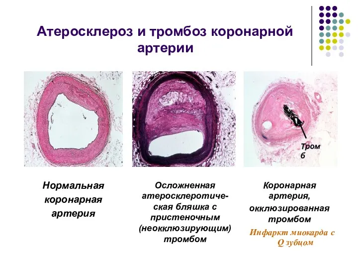 Атеросклероз и тромбоз коронарной артерии