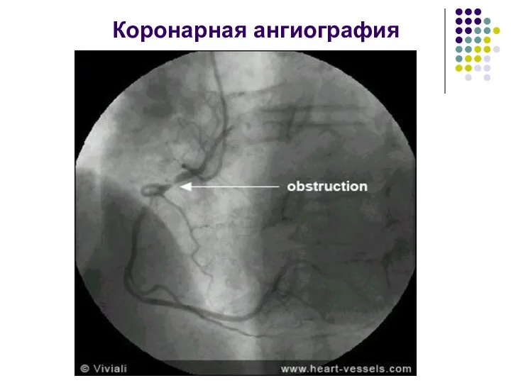 Коронарная ангиография