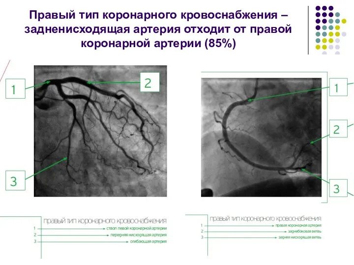 Правый тип коронарного кровоснабжения – задненисходящая артерия отходит от правой коронарной артерии (85%)