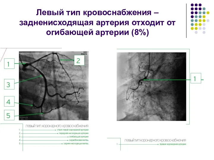 Левый тип кровоснабжения – задненисходящая артерия отходит от огибающей артерии (8%)