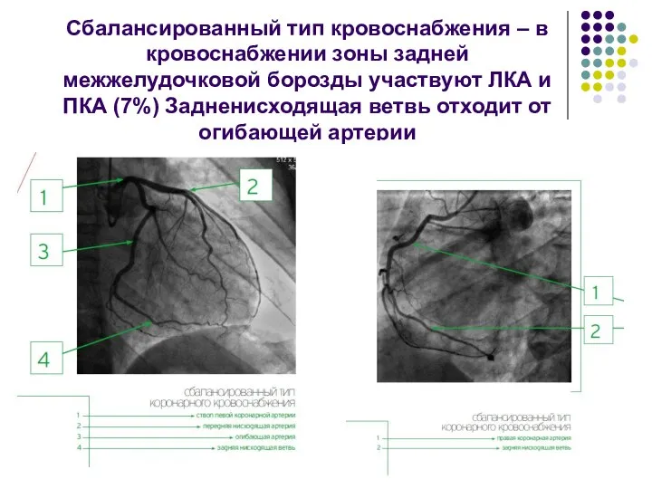 Сбалансированный тип кровоснабжения – в кровоснабжении зоны задней межжелудочковой борозды участвуют