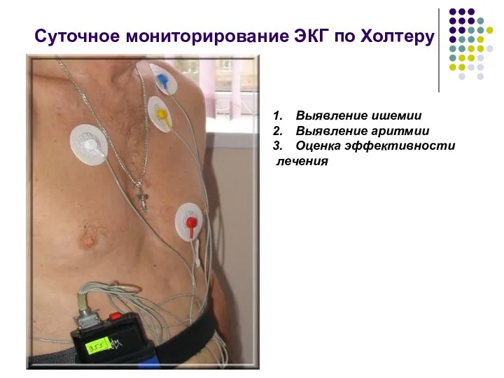 Суточное мониторирование ЭКГ по Холтеру Выявление ишемии Выявление аритмии Оценка эффективности лечения