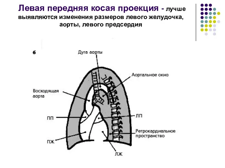 Левая передняя косая проекция - лучше выявляются изменения размеров левого желудочка, аорты, левого предсердия