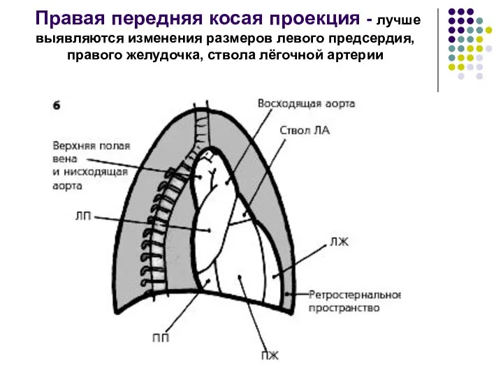 Правая передняя косая проекция - лучше выявляются изменения размеров левого предсердия, правого желудочка, ствола лёгочной артерии