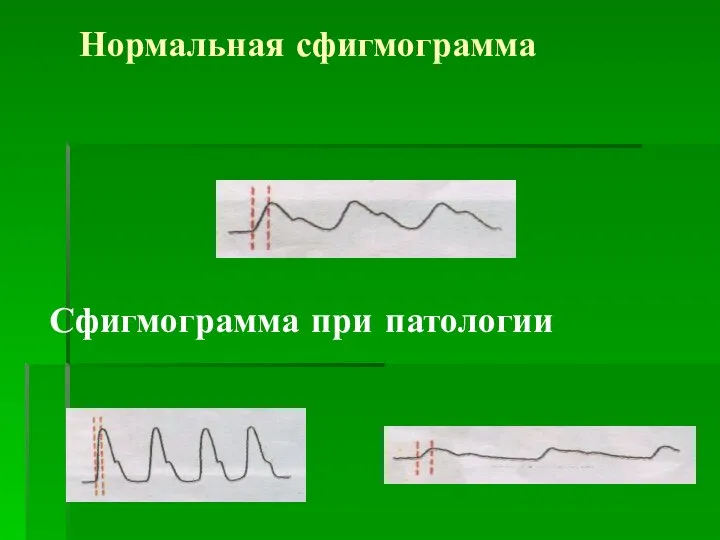 Нормальная сфигмограмма Сфигмограмма при патологии