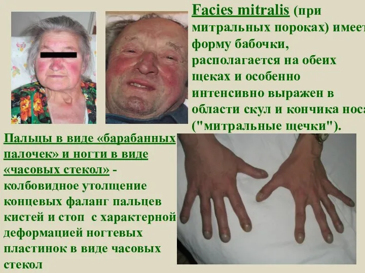 Facies mitralis (при митральных пороках) имеет форму бабочки, располагается на обеих