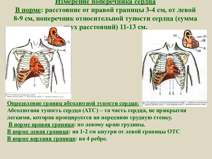 Измерение поперечника сердца В норме: расстояние от правой границы 3-4 см,