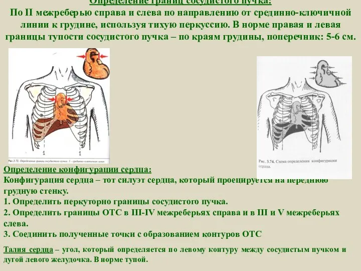 Определение границ сосудистого пучка: По II межреберью справа и слева по
