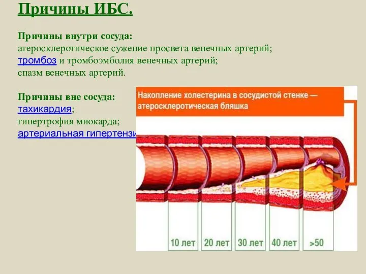 Причины ИБС. Причины внутри сосуда: атеросклеротическое сужение просвета венечных артерий; тромбоз